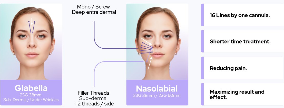 Filler thread techniques — Glabella and Nasolabial