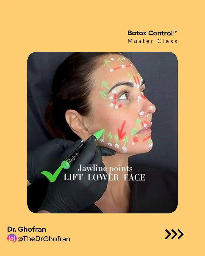 Botox Control™  Master Class